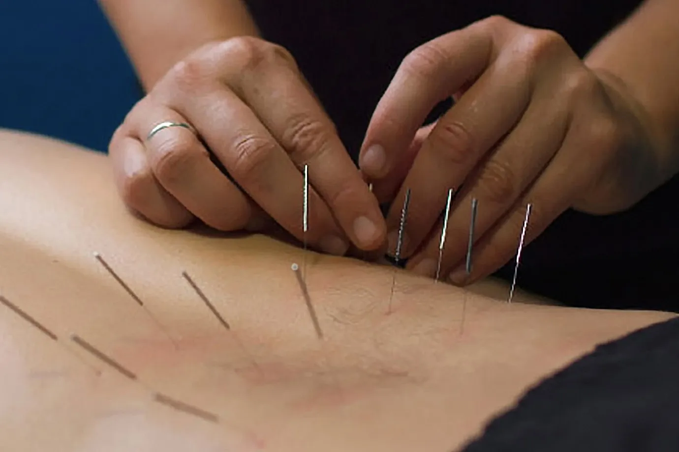 dry needling Fort Smith